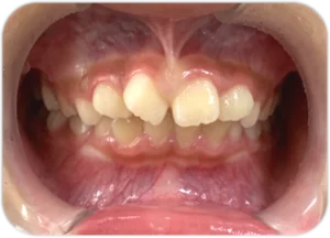 お子さんの５人に４人は歯ならびが悪い！？ 〜ゆい矯正（予防矯正）について〜