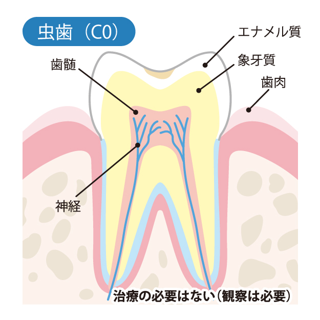 高槻市の歯医者、ゆいファミリー歯科・矯正歯科のむし歯治療の流れ