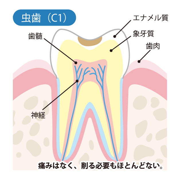 高槻市の歯医者、ゆいファミリー歯科・矯正歯科のむし歯治療の流れ