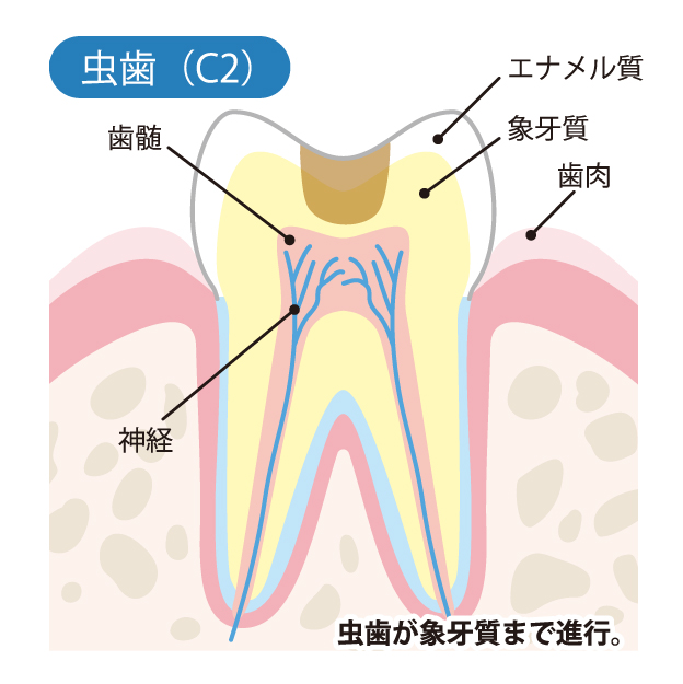 高槻市の歯医者、ゆいファミリー歯科・矯正歯科のむし歯治療の流れ