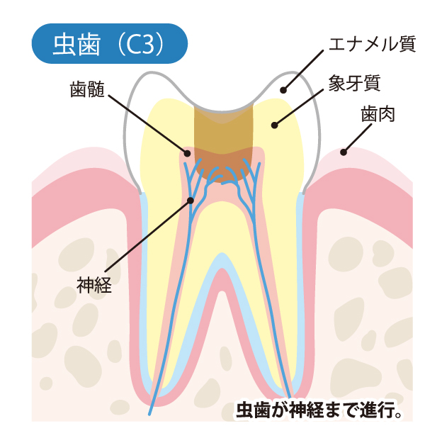 高槻市の歯医者、ゆいファミリー歯科・矯正歯科のむし歯治療の流れ