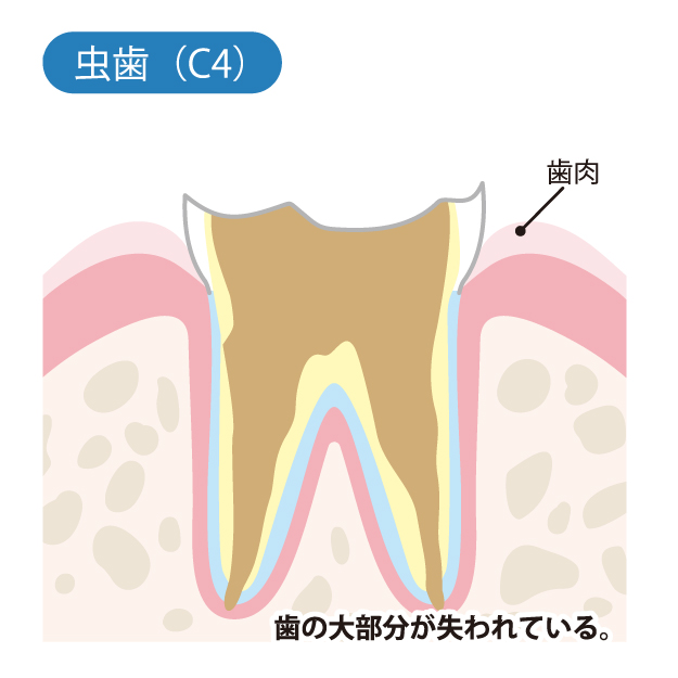 高槻市の歯医者、ゆいファミリー歯科・矯正歯科のむし歯治療の流れ