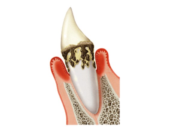 高槻市の歯医者、ゆいファミリー歯科・矯正歯科の歯周病治療